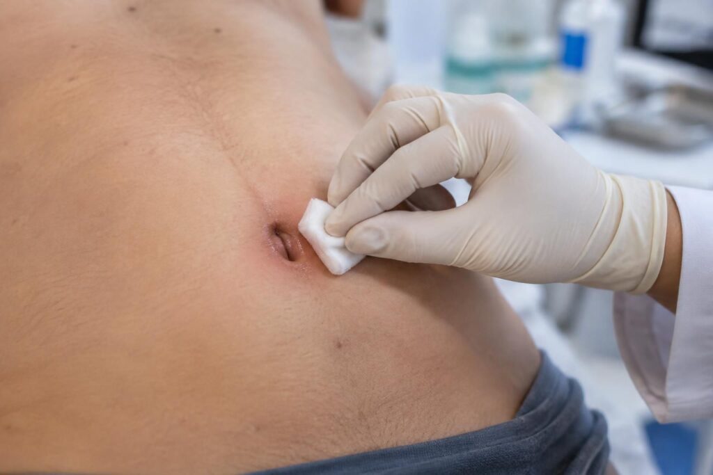 découvrez les symptômes d’un nombril infecté, ses causes fréquentes et les traitements adaptés pour soulager l’infection et savoir quand consulter.